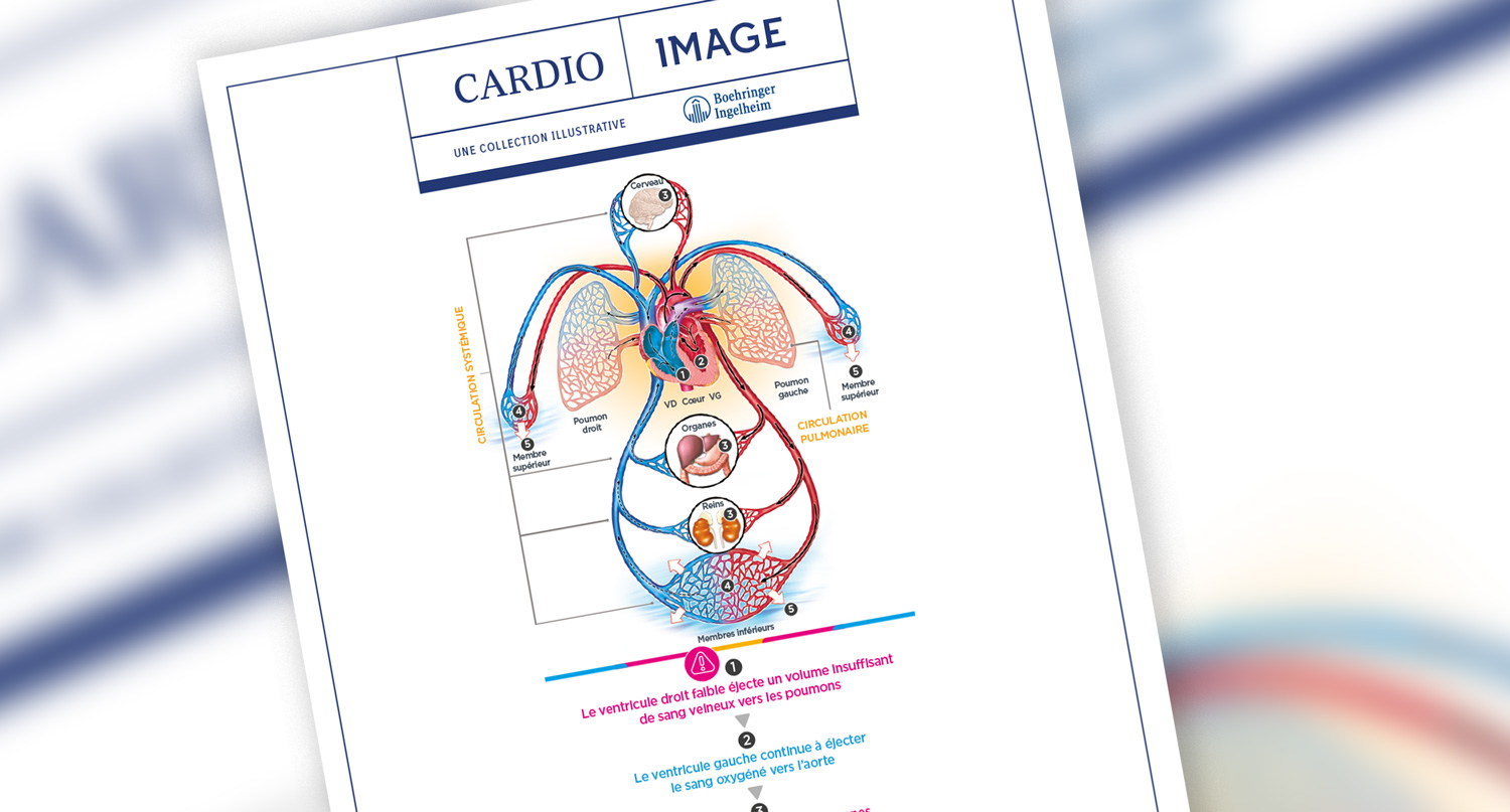 Planche n°3 : Insuffisance cardiaque droite : congestion droite