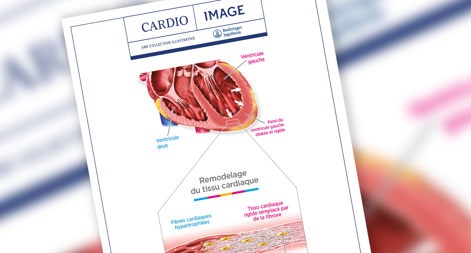 Planche n°5 : Dilatation du ventricule gauche