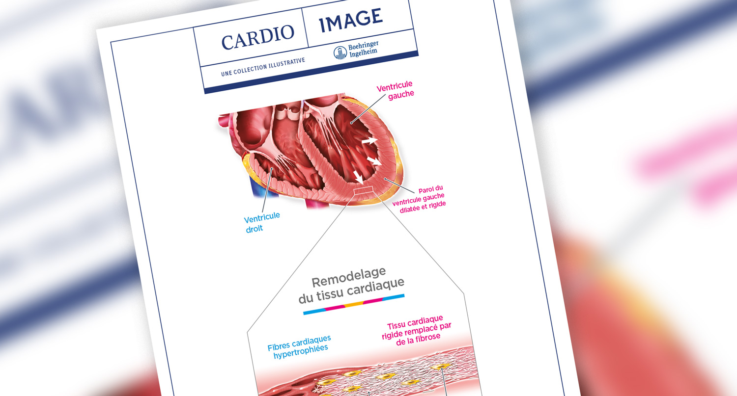 Planche n°6 : Hypertrophie du ventricule gauche