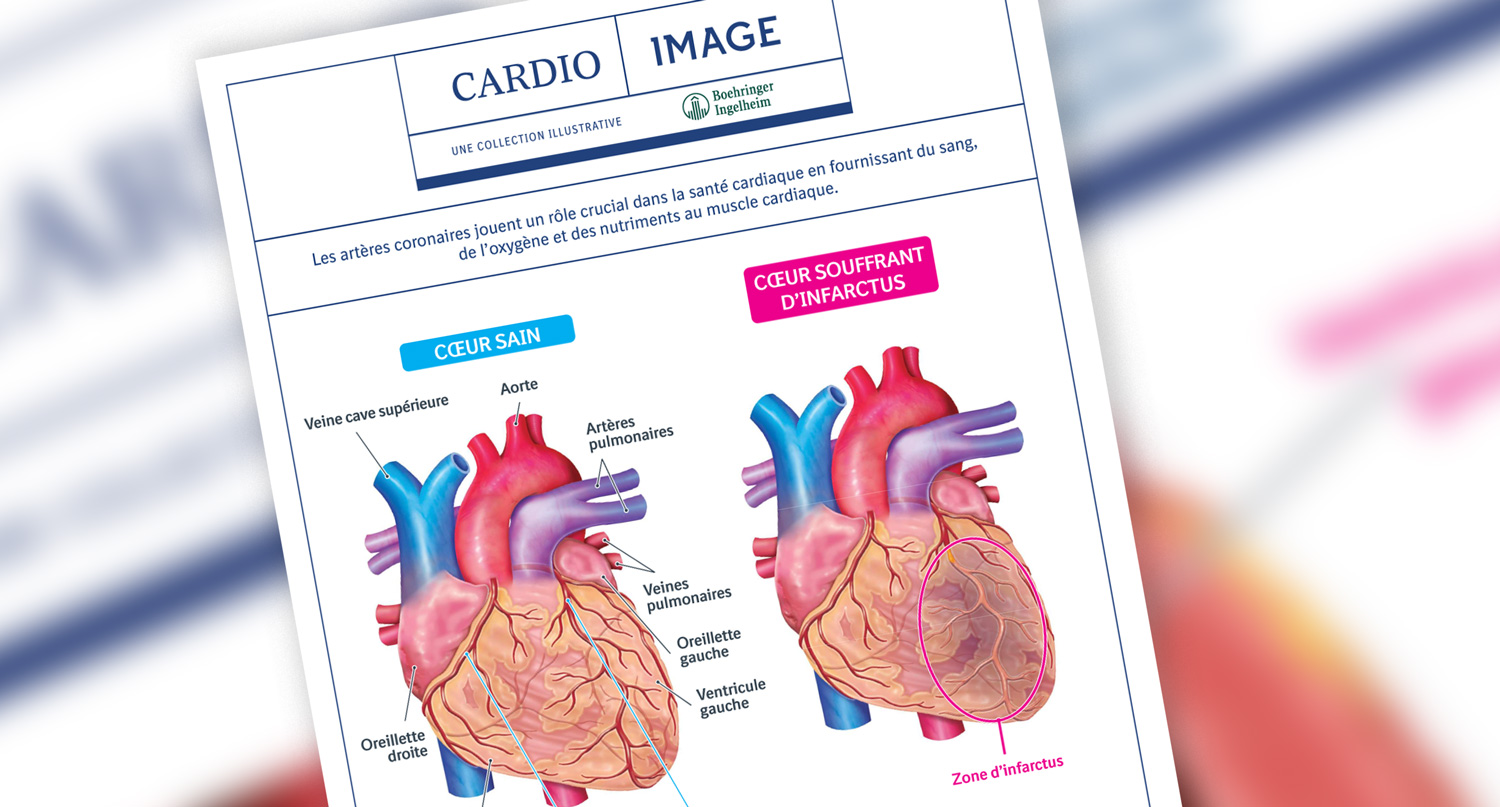 Planche n°7 : Comparaison entre un cœur sain et un cœur malade victime d'un infarctus